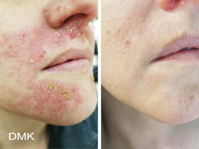 Het gezicht van een vrouw voor en na een DMK-behandeling voor droge huid